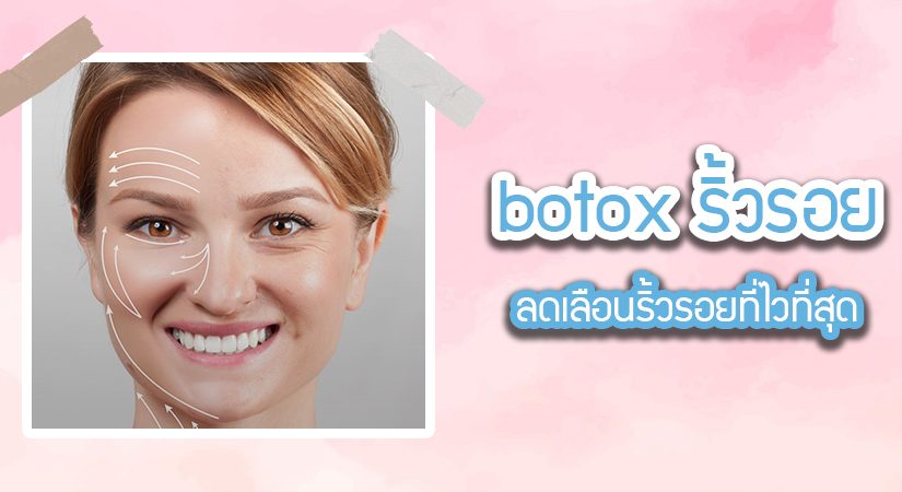 botox ริ้วรอย สามารถฉีดจุดไหนได้บ้าง