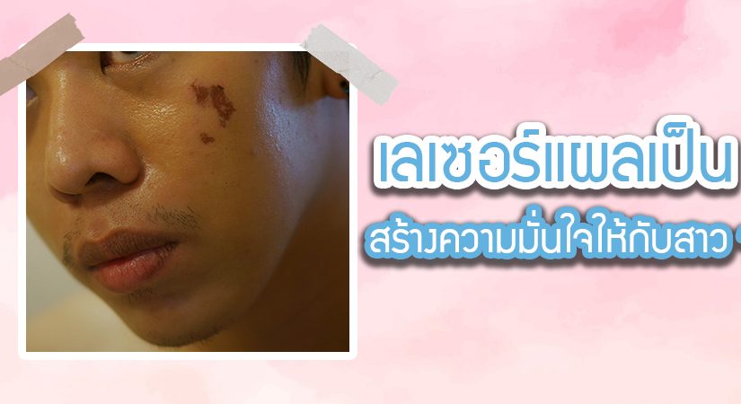 เลเซอร์แผลเป็นมีกี่แบบ ต้องเตรียมตัวอย่างไรก่อนทำเลเซอร์